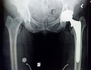 outpatient total hip replacement