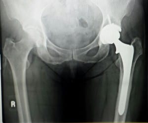 Outpatient Total Hip Replacement