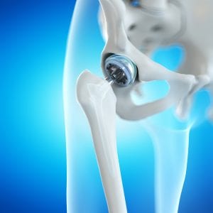 Anterior Hip Replacement