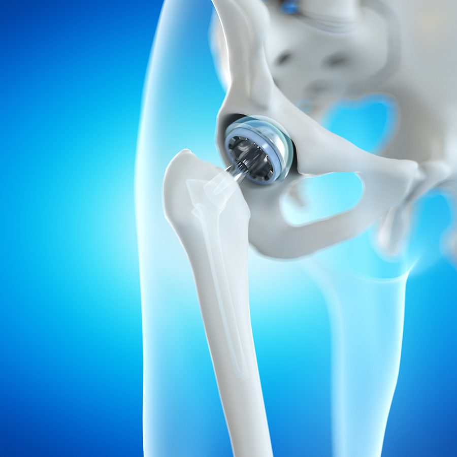 ANTERIOR VS POSTERIOR HIP REPLACEMENT Cedar Orthopaedic Surgery 